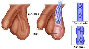Image result for Varicocele