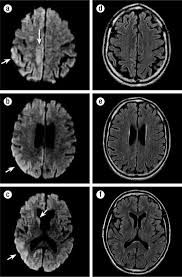 Prion diseases are very rare overall. What Is Creutzfeldt Jakob Disease Classic Cjd Is A Human Prion Disease Creutzfeldt Jakob Disease Cjd Is A Rare Degenerative Disease Neuroscience Disorders