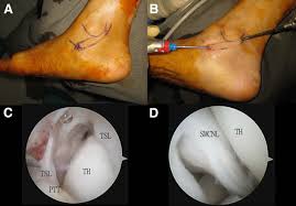Ligament — ligàment (ligamȅnt) m <g mn nātā> definicija anat. Endoscopic Repair Of The Superficial Deltoid Ligament And Spring Ligament Arthroscopy Techniques