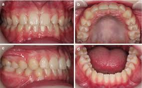 Image result for Dentition
