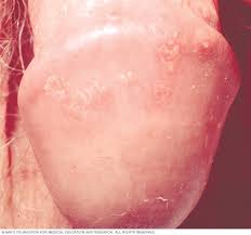 Image result for genital herpes