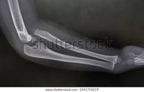 Image result for Radial Head Dislocation