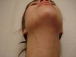 Naturoveda Health World S Answer To What Could Be The Reason For Allergy On My Face Redness Itching Inflammation It Skin Allergies Health World Allergies