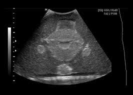 Maybe you would like to learn more about one of these? Female Ultrasound Training Pelvis Cirs