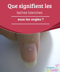 Il peut être situé sur le point de la plaque, la bande ou le couvrir complètement. Que Signifient Les Taches Blanches Sous Les Ongles Ameliore Ta Sante Tache Blanche Ongle Tache Ameliore Ta Sante