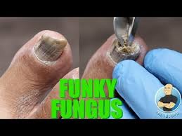 Bioclear Nail Fungus Pen Reviews Have Nail Fungus You Need To Be Doing This Super Important Tip Youtube