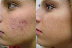 Dog acne has different causes from those leading to human acne. How Long Does It Take For Acne Scars To Heal Acne