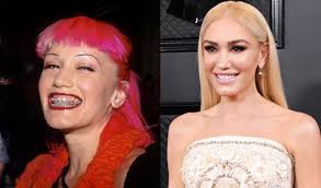 Celebrities With Braces Before And After Famous Brace Faces
