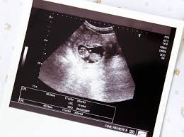 Es gibt zwei operative möglichkeiten, eine schwangerschaft gezielt zu beenden: Fehlgeburt Bei Diesen Anzeichen Solltest Du Zum Arzt Wunderweib