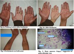 The study of gaisbock's syndrome has been mentioned. Symptom Finder The Causes Of Polycythemia Medical Zone