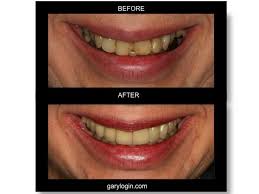 Over 10 million people worldwide have beautified their smile with invisalign. Full Mouth Reconstruction Condition Large Fillings In Back And Front Teeth Had Cracks And Cavities Garyrlogindmd Garylogin Dentist Cosmetic Dentistry Dental