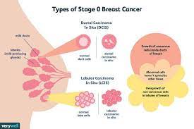 Knowing the type of breast cancer you have helps your doctors decide on the best treatment for you. Breast Cancer Types Symptoms Diagnosis Treatment Pmcc Denver Oncology Denver Concierge Medicine