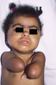 Image result for Hypertrichosis