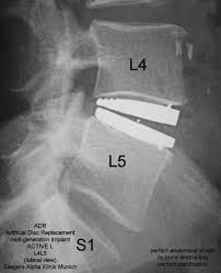 Pin On Artificial Total Disc Replacement This Is The Surgery I Need