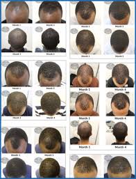 Male pattern baldness genetic condition caused by variety factors. Is It True Nothing Can Be Done About Male Pattern Baldness