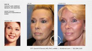 Louisville Facelift Expert