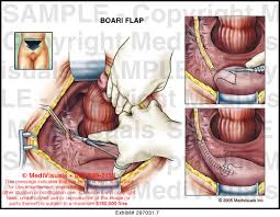 I won a medal in. Boari Flap Medical Illustration Medivisuals