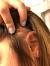 Infected Ingrown Hair Cyst