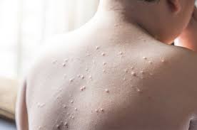 Download demam campak apk android game for free to your android phone. Nimelesh On Twitter Kerap Orang Confuse Yang Demam Campak Ini Chicken Pox Demam Campak Measles Chicken Pox Cacar Air Campak Cacar Air Https T Co 8f8mjbbpct