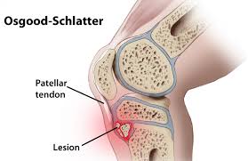 Osgood Schlatter Disease Family Sports Chiropractor