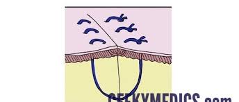 The advantages of the vertical mattress suture are that it provides closure for both deep and superficial layers, and also allows perfect eversion and vertical opposition of the superficial skin edges. Vertical Mattress Suture Osce Guide Geeky Medics