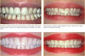 Check spelling or type a new query. Porcelain Veneers Chester County Family Dentistry