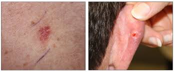It might look skin coloured, waxy, like a scar or thickened area of skin that's very slowly getting bigger. Figure Basal Cell Carcinoma A Skin Pdq Cancer Information Summaries Ncbi Bookshelf