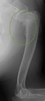 Weight loss is a particularly common sign of cancer in dogs and may indicate a gastrointestinal. Reuben S Experience With Surgery And Chemotherapy For Osteosarcoma