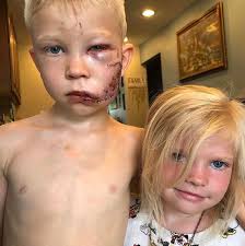 If a cut is more than.25 inches deep, then you should consider getting stitches. On Saving His Sister From A Dog Attack If Someone Had To Die I Thought It Should Be Me Pics