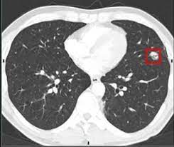 Lung nodules, pulmonary nodules, white spots, lesions—these terms all describe the same phenomenon: Lung Cancer Screening Ct San Diego Imaging Radiology