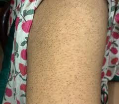 Image result for Keratosis pilaris