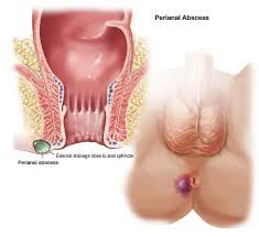 Image result for Perianal Abscess
