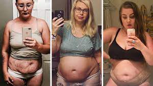 Body lift surgery is one of the most common procedures used to improve the body's appearance after weight loss surgery. Mutter Zeigen Echte After Baby Bodys