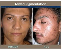 Image result for Melasma