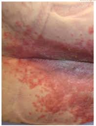 Image result for Candidiasis under breasts