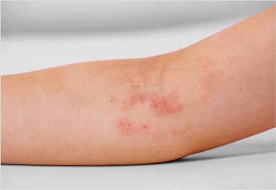 Viêm da dị ứng là gì? Nguyên nhân, triệu chứng và cách điều trị