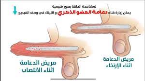 دعامة القضيب (دعامة العضو الذكري) لعلاج ضعف الانتصاب | دار الذكورة