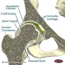 Image result for Hip Labral Tear
