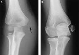 Treatment of pediatric humeral medial epicondyle fractures is controversial. Unrecognized Fracture Of The Medial Epicondylar Apophysis Of The Humerus Journal Of Shoulder And Elbow Surgery