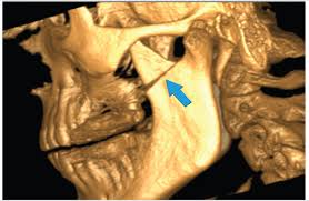 Image result for Coronoid Process Fracture