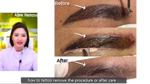It is gentle on the skin. Permanent Makeup Removal Non Laser By Aljee Method Latest Techniques No Scars Youtube