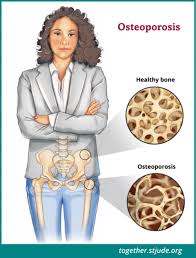 The cancers that children and teenagers get are not considered preventable or. Bone Loss And Osteoporosis In Childhood Cancer Survivors Together