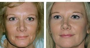 Sculptra should not be injected into the blood vessels as it may cause vascular occlusion, infarction or embolic phenomena. Sculptra Before And After Pictures Dr Turowski Plastic Surgery Chicago