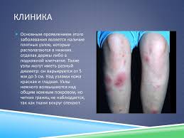 У пациента на коже появляются бугры и узлы красного цвета, кожа становится неровной. Uzlovataya Eritema Online Presentation
