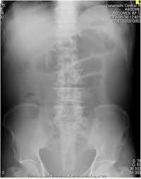 It's often described as a bright red or fresh looking. A Case Of Advanced Rectal Cancer With Rectovesical And Ileal Fistulae That Developed Hyperammonemic Encephalopathy Surgical Case Reports Full Text