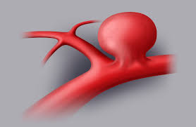 Apenas 2/3 dos pacientes sobrevivem, e cerca de metade dos que sobrevivem permanece com sequelas. Aneurismi Cerebrali Sintomi Diagnosi E Trattamento Benech Neurochirurgia