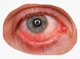 Here are the top 10 causes of red eye, from pink eye to 18 reasons you may have red and bloodshot eyes. Bloodshot Eyes Png Transparent Png Transparent Png Image Pngitem