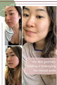 Testosterone levels go up in the teenage years as part of puberty. My Hormonal Acne Journey Healing Managing Acne Living Minnaly