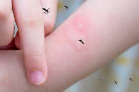 Image result for mosquito bite