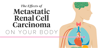 The Effects Of Metastatic Renal Cell Carcinoma On The Body Polish your personal project or design with these kidney transparent png images, make it even more personalized and more. metastatic renal cell carcinoma